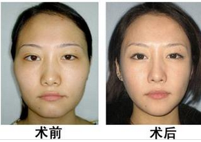 选用哪种丰额头整形手术果更好？