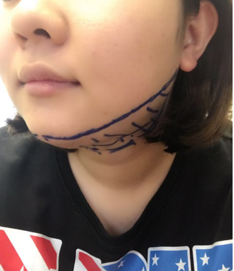 瘦脸的方法---吸脂手术果对比图