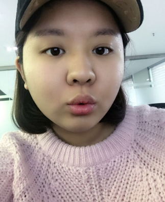 瘦脸的方法---吸脂手术果对比图