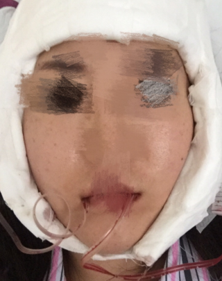 从下颌角整形手术案例分析影响没问题性的因素有