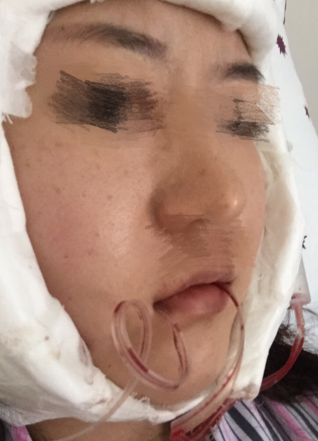 从下颌角整形手术案例分析影响没问题性的因素有