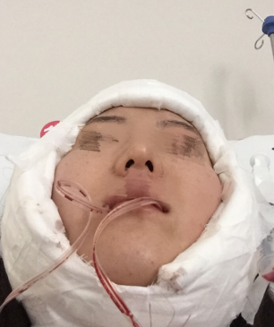 从下颌角整形手术案例分析影响没问题性的因素有