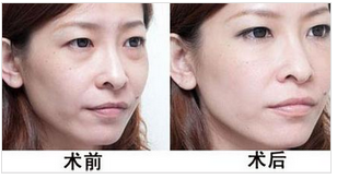 手术法去眼袋术后果能保持多久?