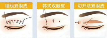 北京华美整形医院割双眼皮的方法有哪些?