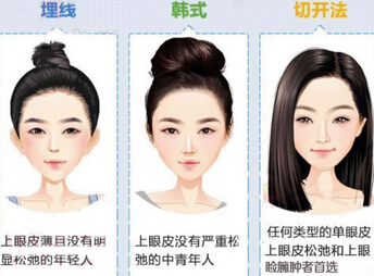 北京华美整形医院割双眼皮的方法有哪些?