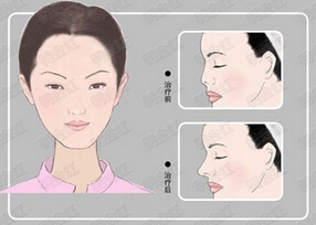 北京美联臣注射隆鼻后还可以做假体隆鼻吗?