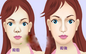 北京叶子整形医院什么时候做隆鼻失败修复较好