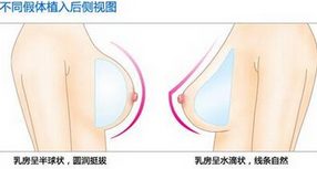 哪家整形医院做假体隆胸好,多少钱?