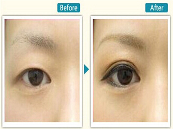 李静林割双眼皮手术多少钱?
