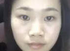 眼睛鼻子泪沟太阳穴手术设计果分享