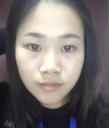 眼睛鼻子泪沟太阳穴手术设计果分享