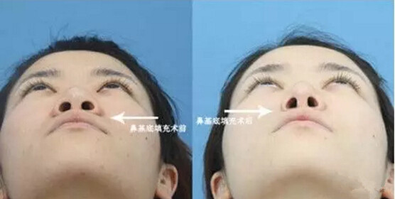 眼睛鼻子泪沟太阳穴手术设计果分享