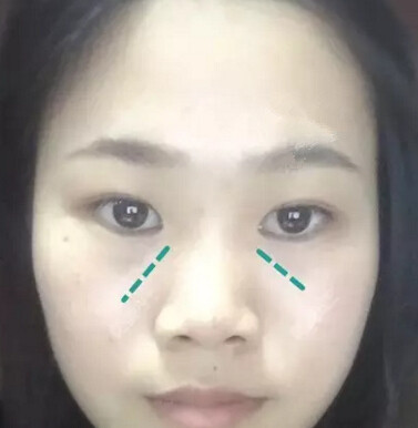 眼睛鼻子泪沟太阳穴手术设计果分享