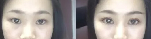 眼睛鼻子泪沟太阳穴手术设计果分享