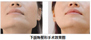 上海华美整形医院做下颌角整形怎么样?