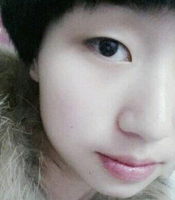 南京医科大学第二附属医院李昌医生割双眼皮