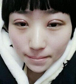 南京医科大学第二附属医院李昌医生割双眼皮