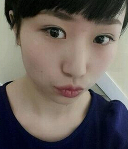 南京医科大学第二附属医院李昌医生割双眼皮