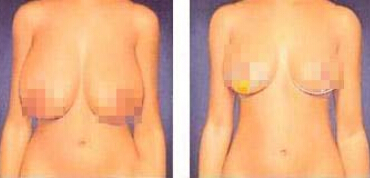 巨乳缩小手术果如何