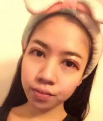 双眼皮手术案例分享,做了双眼皮的一些感受和