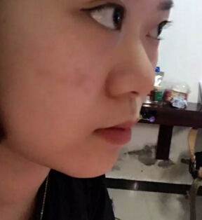 隆鼻2个月后,我居然瘦了这么多!