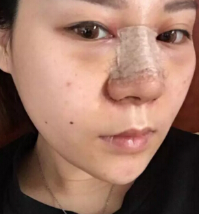 隆鼻2个月后,我居然瘦了这么多!