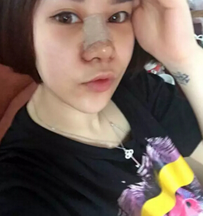 隆鼻2个月后,我居然瘦了这么多!