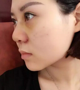 隆鼻2个月后,我居然瘦了这么多!