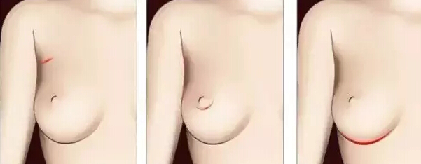 隆胸到底选自体脂肪还是假体好?