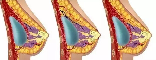 隆胸到底选自体脂肪还是假体好?