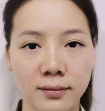深圳盛美佳医疗整形美容张亚梅做的鼻部手术整形