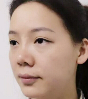 深圳盛美佳医疗整形美容张亚梅做的鼻部手术整形