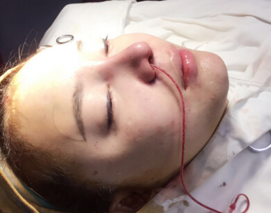 深圳盛美佳医疗整形美容张亚梅做的鼻部手术整形