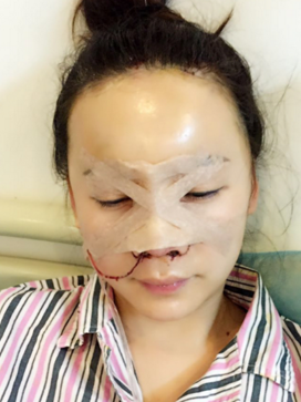 深圳盛美佳医疗整形美容张亚梅做的鼻部手术整形
