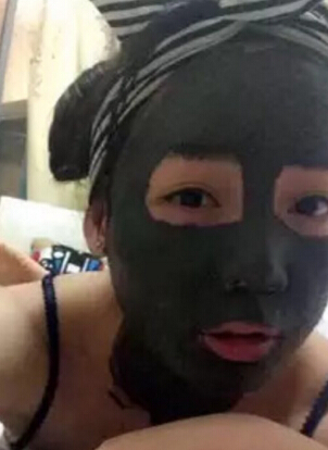 深圳盛美佳医疗整形美容张亚梅做的鼻部手术整形