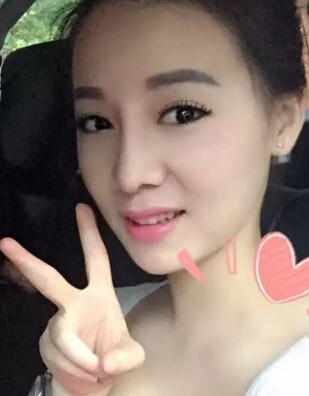 深圳盛美佳医疗整形美容张亚梅做的鼻部手术整形