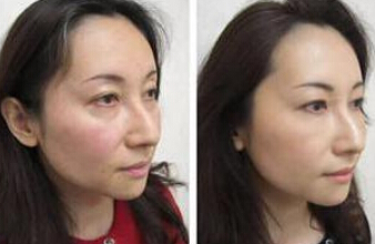 光子嫩肤去黑眼圈果如何
