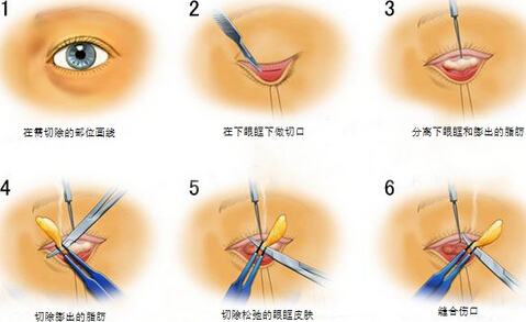 广州曙光整形做祛除眼袋手术价格要多少钱?