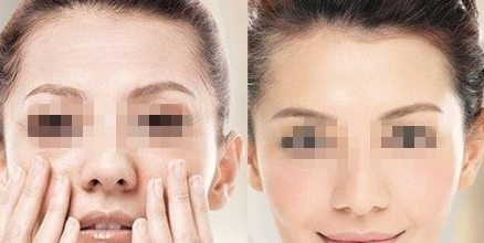 自体脂肪隆眉弓果怎样?