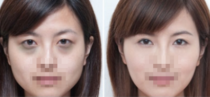 激光去黑眼圈果好不好?