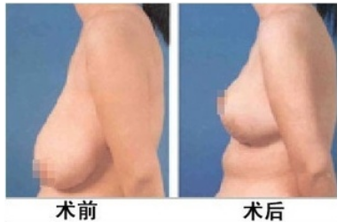 乳房下垂上提术有风险吗?