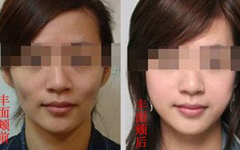 面部填充的果怎么样?