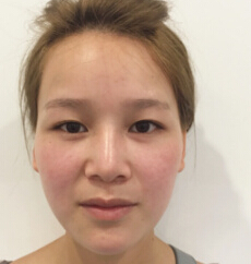 硅胶隆鼻手术案例、费用,注意事项