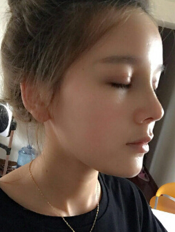 硅胶隆鼻手术案例、费用,注意事项