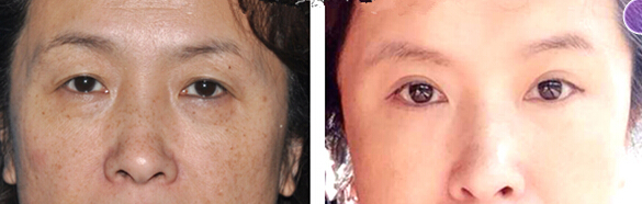 提眉术的果到底如何?