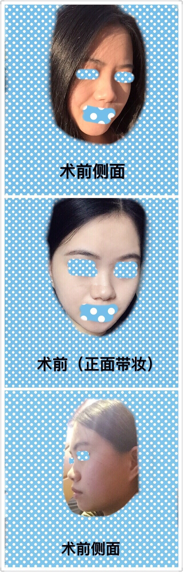7年1月15号湘雅附二王先成教授做的隆鼻部手术整形