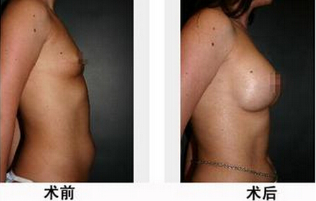 隆胸手术后会影响女人哺乳吗?