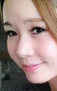 常见畸形鼻的手术调节