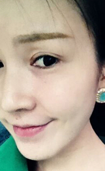 常见畸形鼻的手术调节