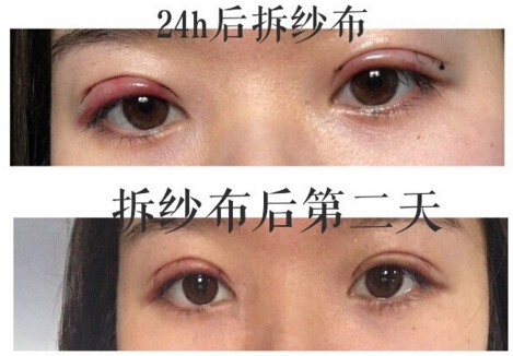 上海九院金蓉医生做的双眼皮手术果